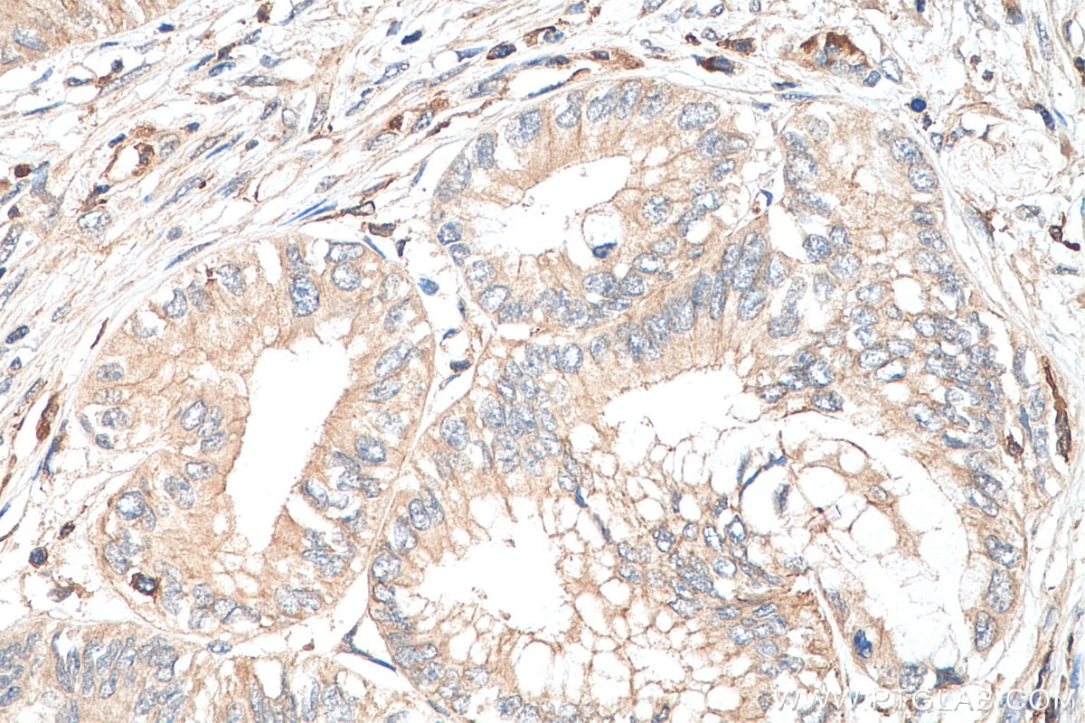 IHC staining of human pancreas cancer using 20696-1-AP Immunohistochemistry (IHC) staining of human pancreas cancer tissue using SSTR3 Polyclonal antibody (20696-1-AP)