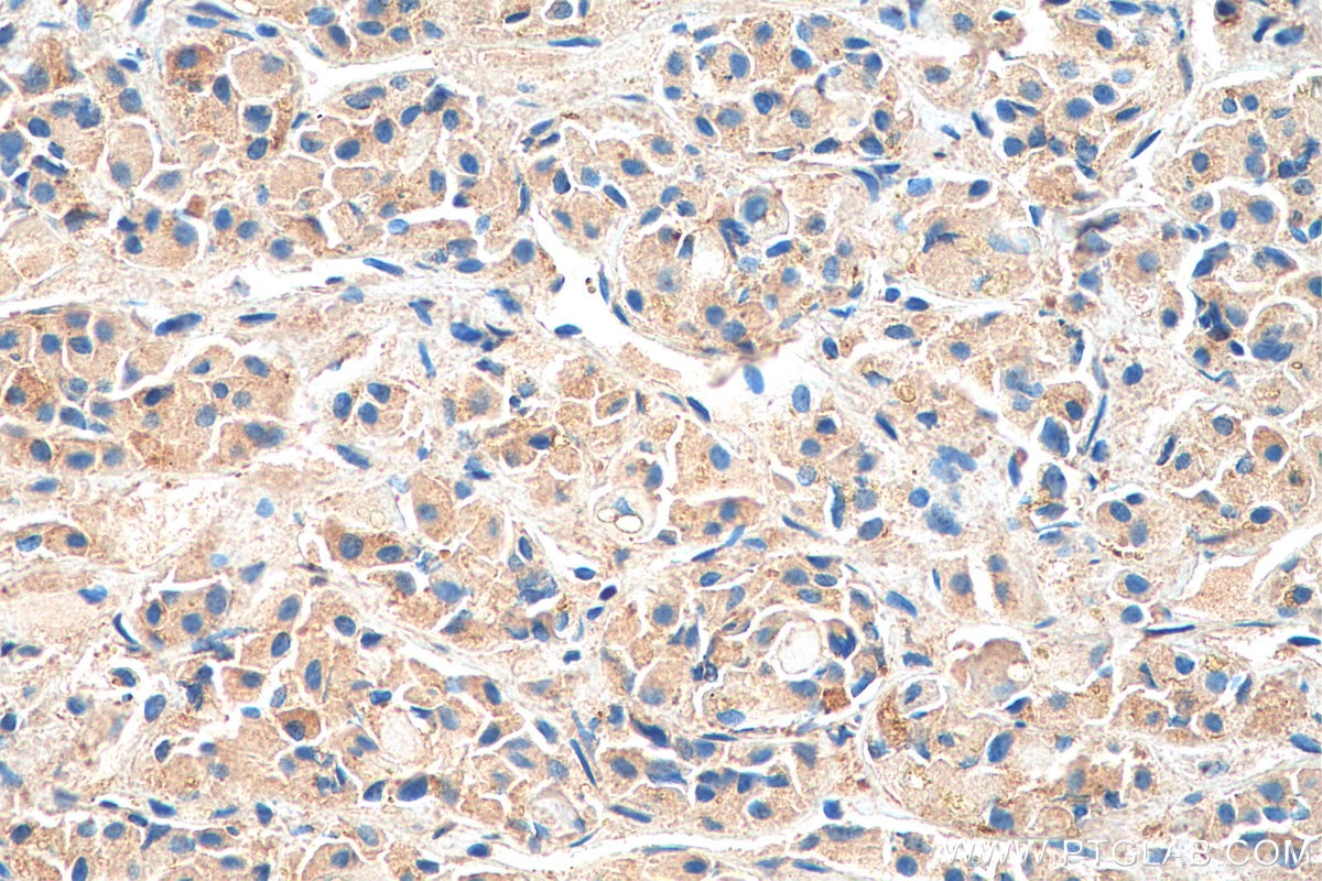 IHC staining of human pituitary using 20696-1-AP Immunohistochemistry (IHC) staining of human pituitary tissue using SSTR3 Polyclonal antibody (20696-1-AP)