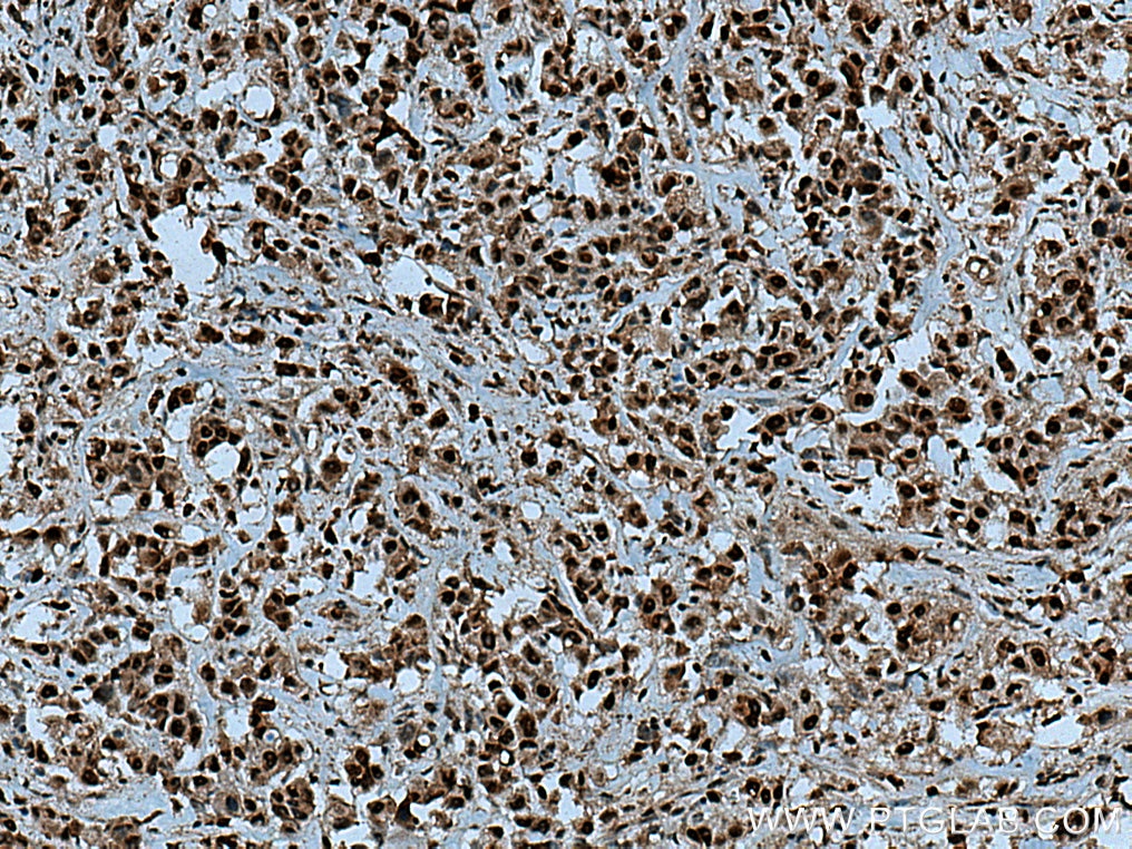 Immunohistochemistry (IHC) staining of human breast cancer tissue using SSU72 Polyclonal antibody (15434-1-AP)