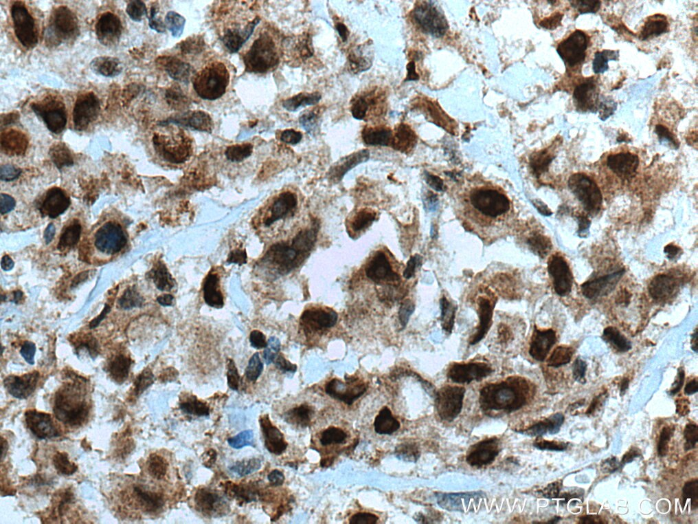 Immunohistochemistry (IHC) staining of human breast cancer tissue using SSU72 Polyclonal antibody (15434-1-AP)