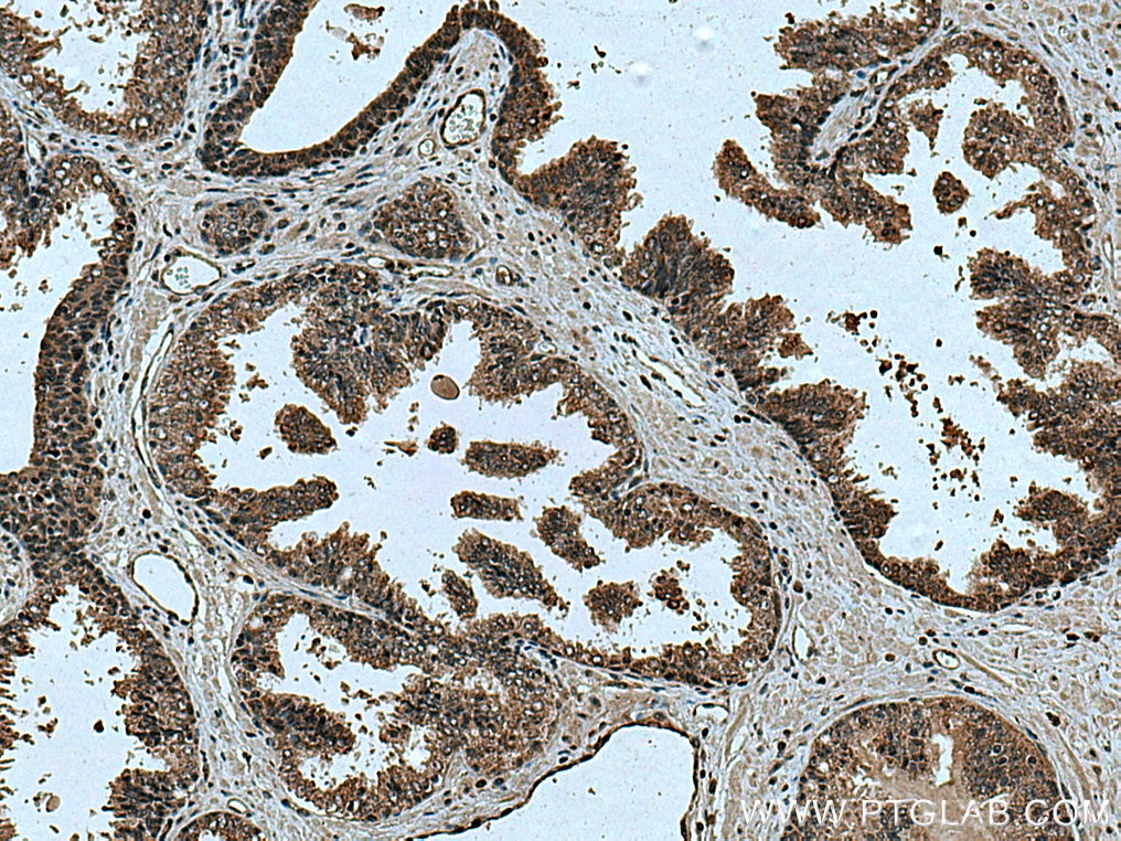 Immunohistochemistry (IHC) staining of human prostate cancer tissue using SSU72 Polyclonal antibody (15434-1-AP)