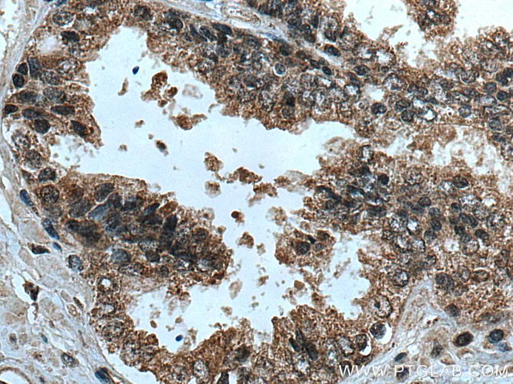 Immunohistochemistry (IHC) staining of human prostate cancer tissue using SSU72 Polyclonal antibody (15434-1-AP)