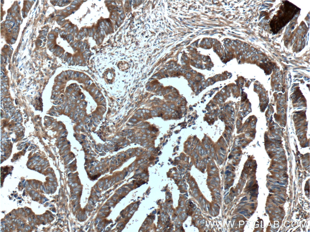 IHC staining of human colon cancer using 26581-1-AP