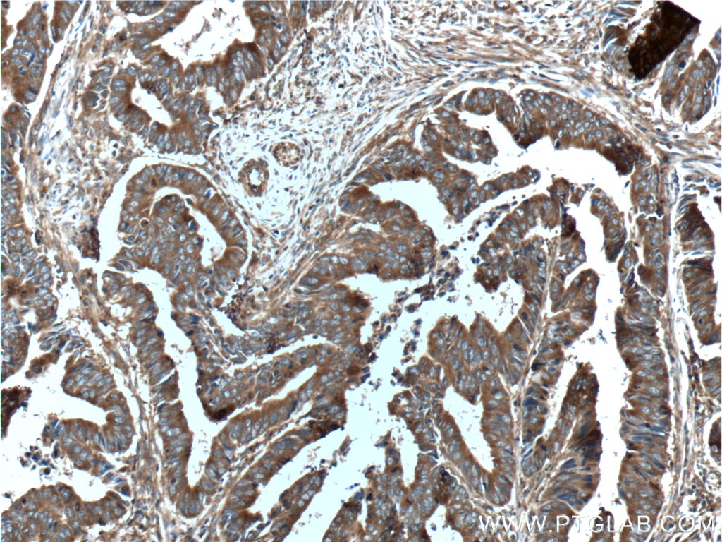 Immunohistochemistry (IHC) staining of human colon cancer tissue using ST13 Polyclonal antibody (26581-1-AP)