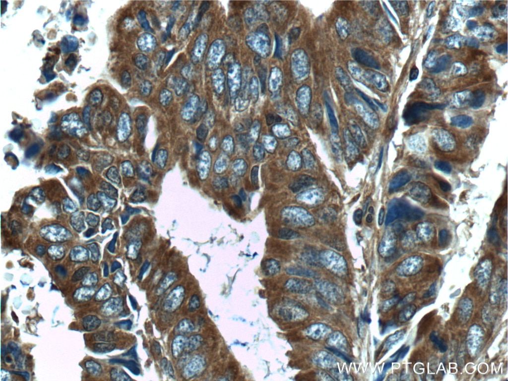 Immunohistochemistry (IHC) staining of human colon cancer tissue using ST13 Polyclonal antibody (26581-1-AP)