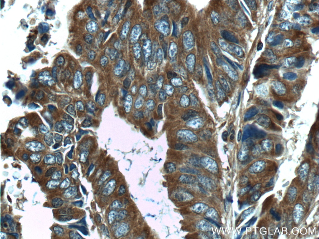 IHC staining of human colon cancer using 26581-1-AP