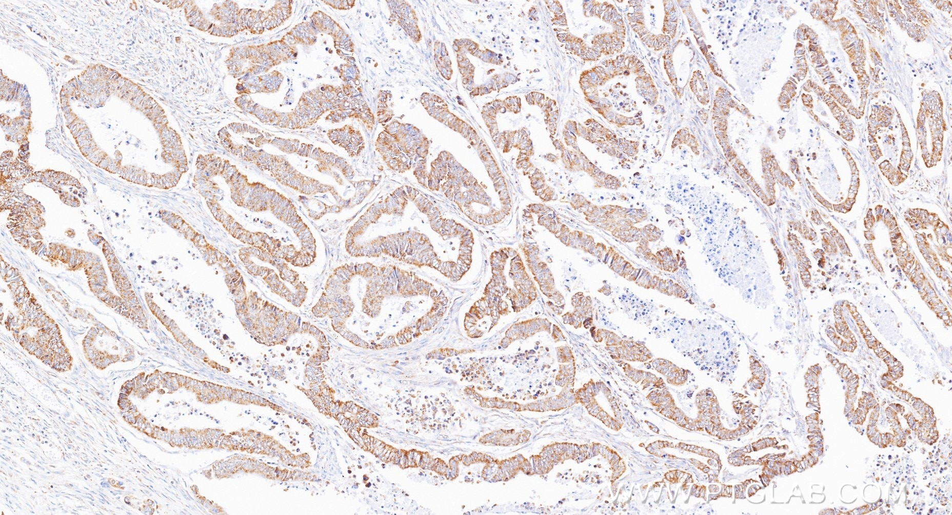 Immunohistochemistry (IHC) staining of human colon cancer tissue using ST3GAL2 Recombinant monoclonal antibody (85634-2-RR)