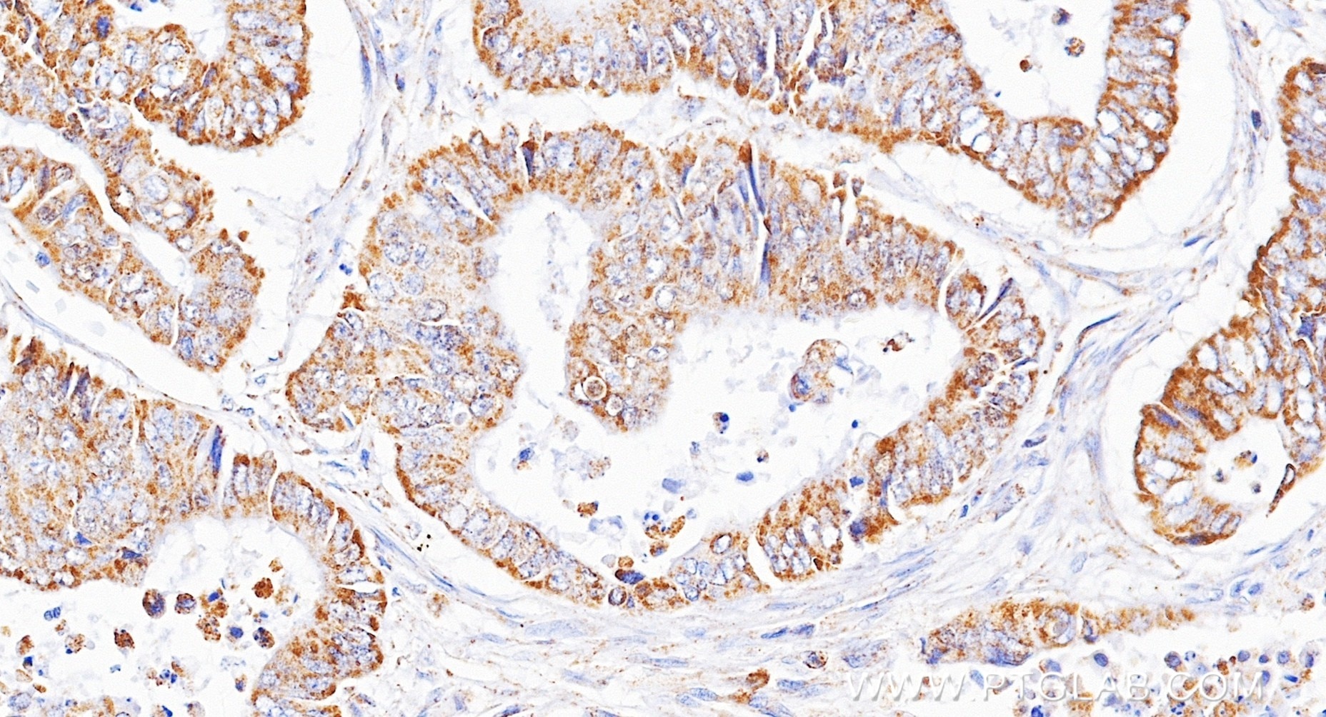 Immunohistochemistry (IHC) staining of human colon cancer tissue using ST3GAL2 Recombinant monoclonal antibody (85634-2-RR)
