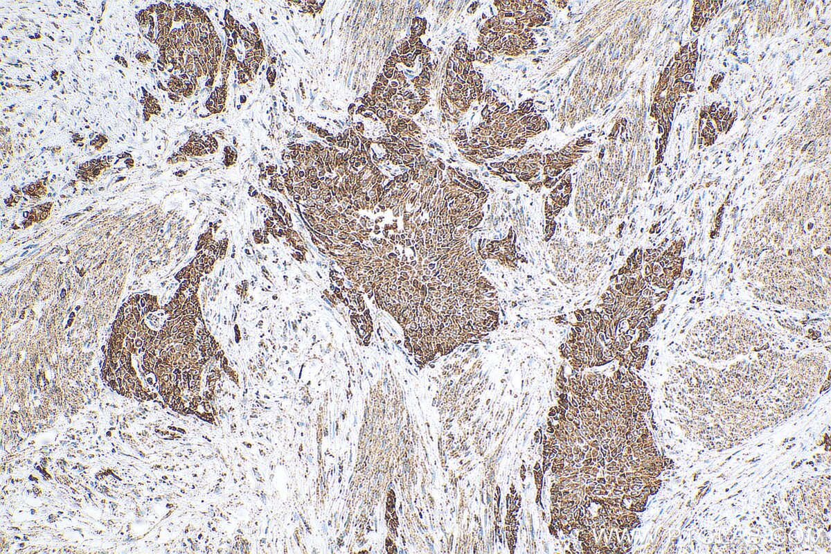 Immunohistochemistry (IHC) staining of human urothelial carcinoma tissue using ST3GAL6 Polyclonal antibody (13154-1-AP)