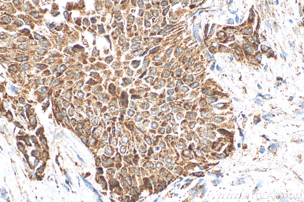 Immunohistochemistry (IHC) staining of human urothelial carcinoma tissue using ST3GAL6 Polyclonal antibody (13154-1-AP)