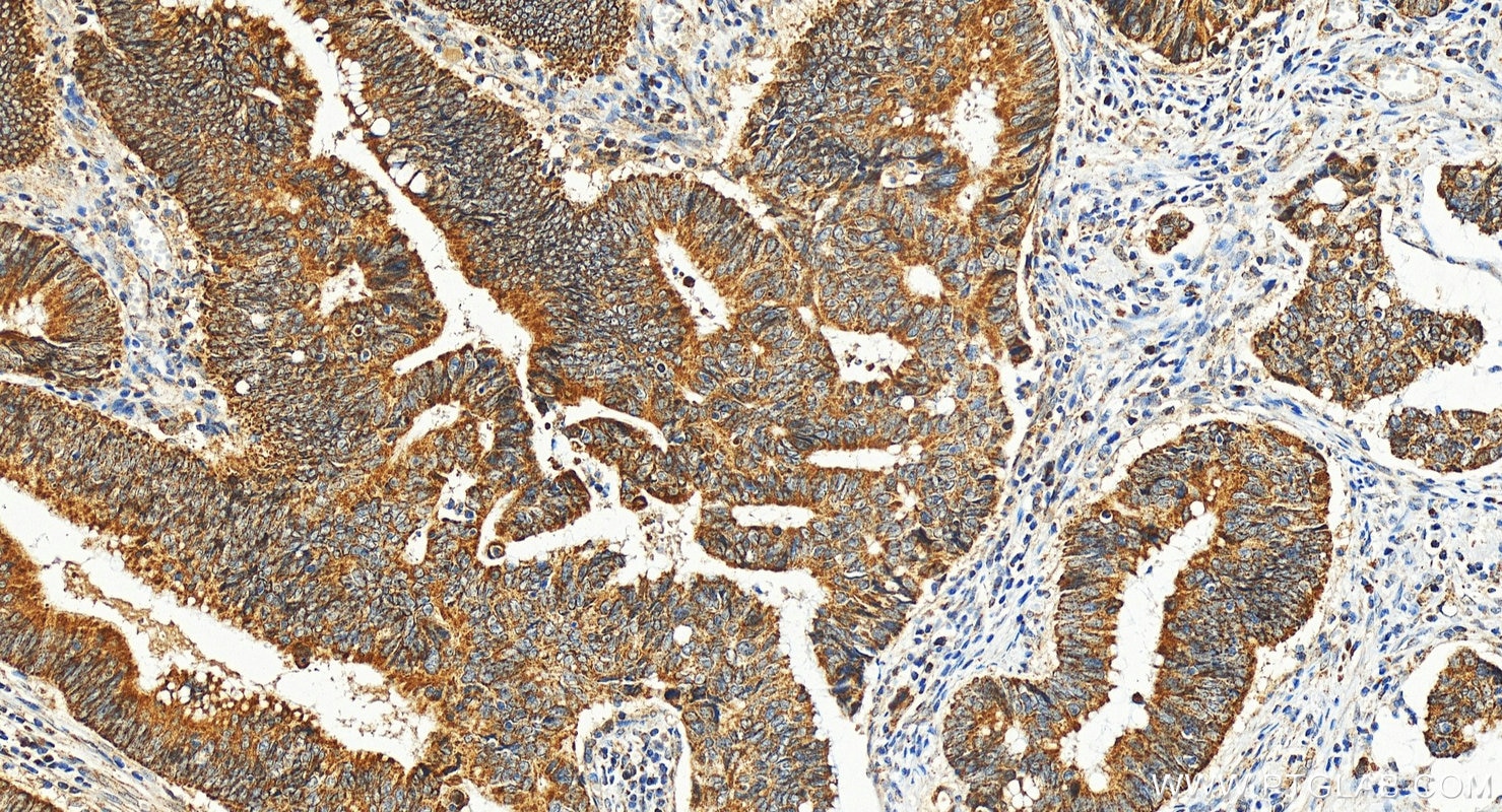 Immunohistochemistry (IHC) staining of human colon cancer tissue using ST6GAL1 Polyclonal antibody (14355-1-AP)