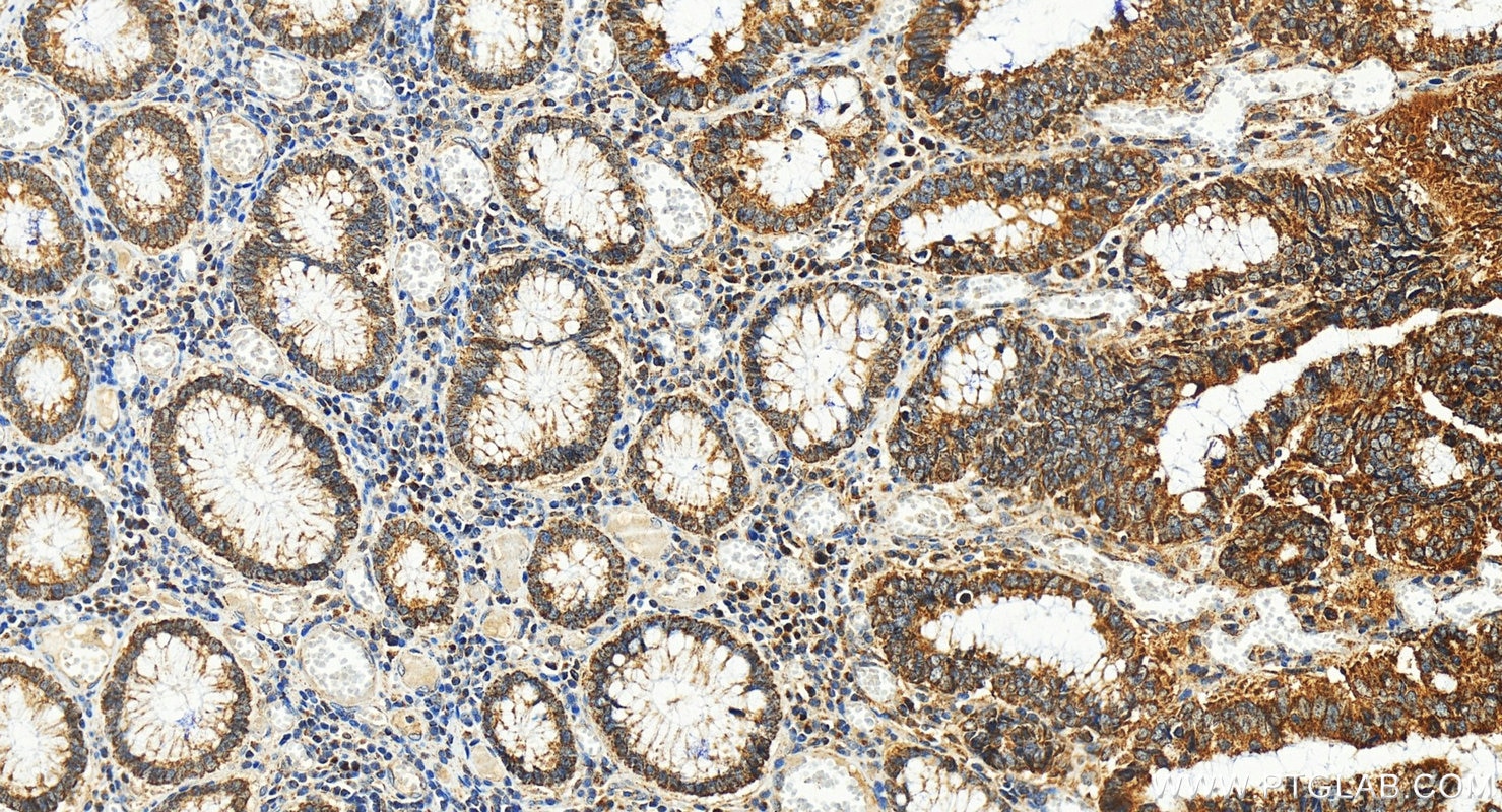 Immunohistochemistry (IHC) staining of human colon cancer tissue using ST6GAL1 Polyclonal antibody (14355-1-AP)