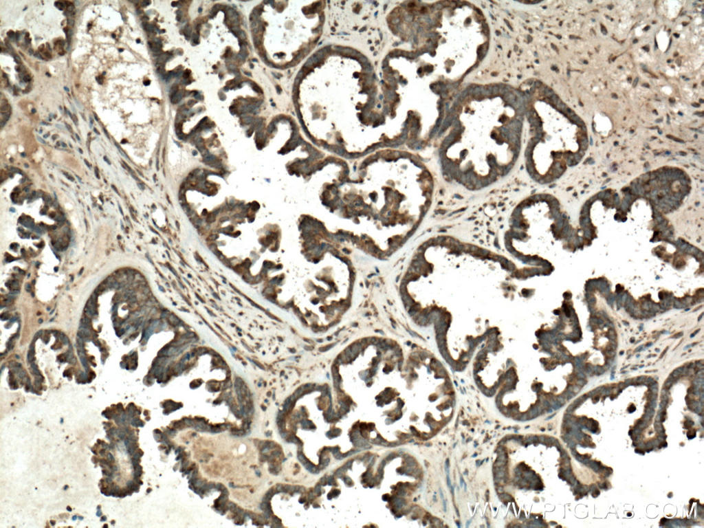 Immunohistochemistry (IHC) staining of human ovary tumor tissue using ST6GAL1 Polyclonal antibody (14355-1-AP)