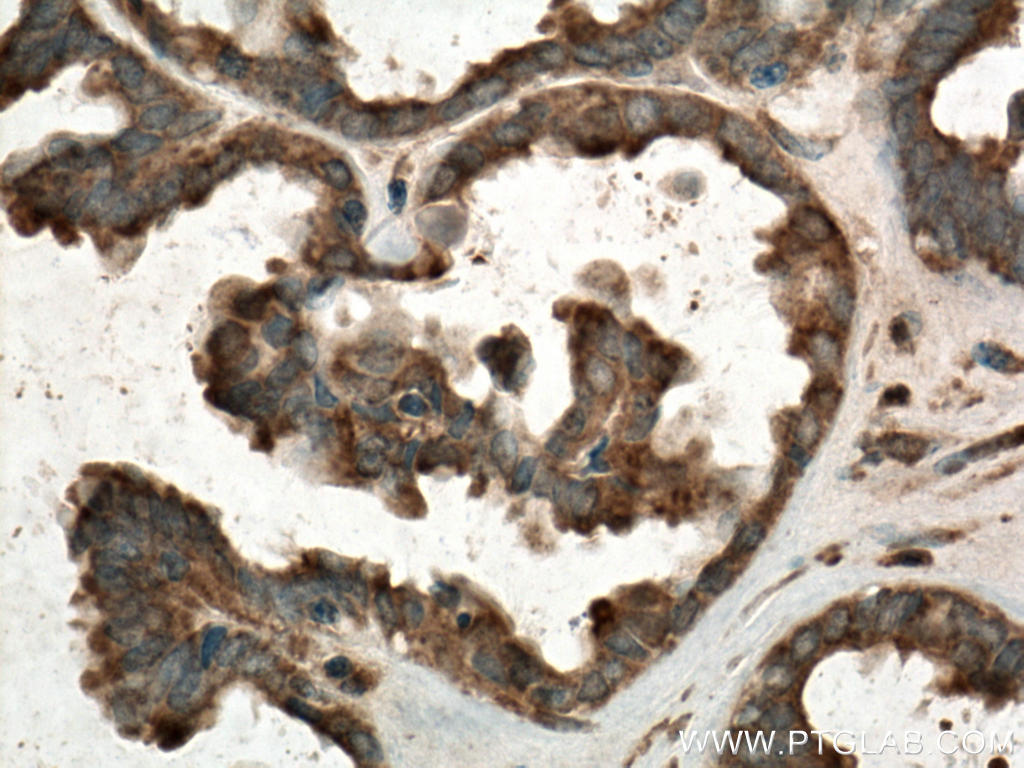 IHC staining of human ovary tumor using 14355-1-AP