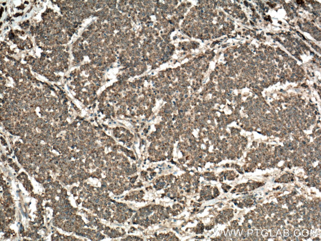 Immunohistochemistry (IHC) staining of human colon cancer tissue using ST6GAL1 Polyclonal antibody (14355-1-AP)