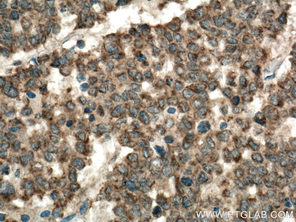Immunohistochemistry (IHC) staining of human colon cancer tissue using ST6GAL1 Polyclonal antibody (14355-1-AP)