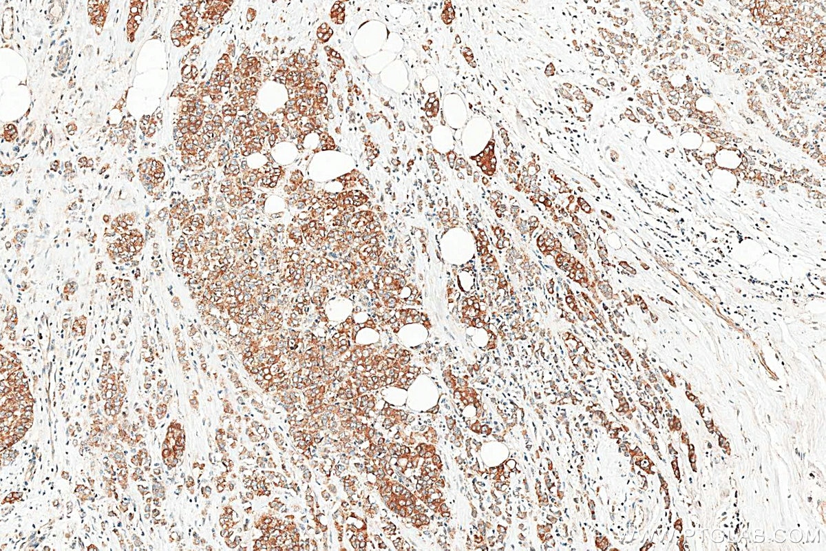 IHC staining of human breast cancer using 16442-1-AP Immunohistochemistry (IHC) staining of human breast cancer tissue using ST6GALNAC5 Polyclonal antibody (16442-1-AP)