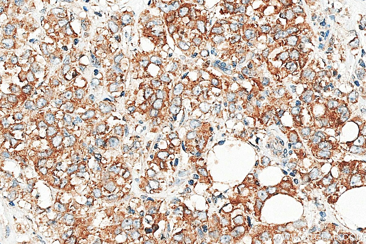 IHC staining of human breast cancer using 16442-1-AP Immunohistochemistry (IHC) staining of human breast cancer tissue using ST6GALNAC5 Polyclonal antibody (16442-1-AP)