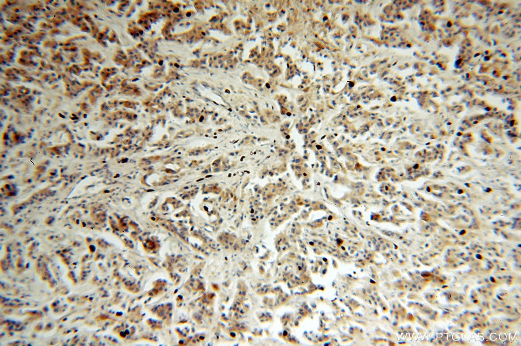 Immunohistochemistry (IHC) staining of human breast cancer tissue using ST6GALNAC5 Polyclonal antibody (16442-1-AP)