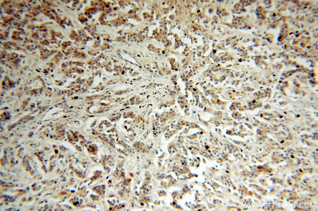 IHC staining of human breast cancer using 16442-1-AP