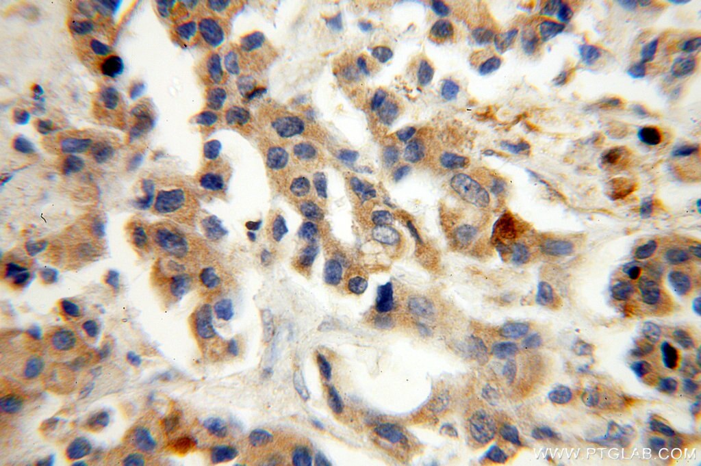 Immunohistochemistry (IHC) staining of human breast cancer tissue using ST6GALNAC5 Polyclonal antibody (16442-1-AP)