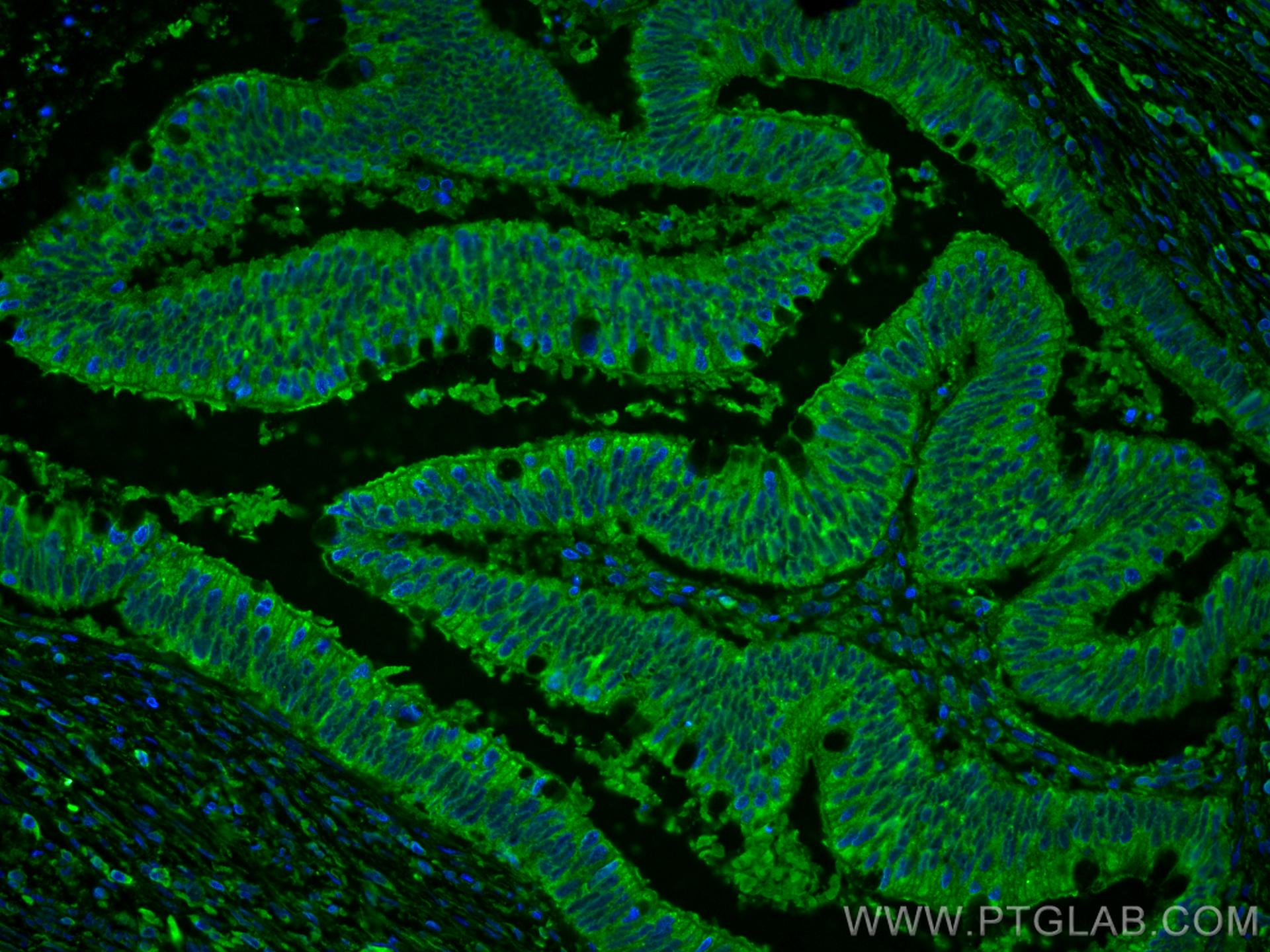 Immunofluorescence (IF) / fluorescent staining of human colon cancer tissue using ST6GALNAC6 Monoclonal antibody (66209-1-Ig)
