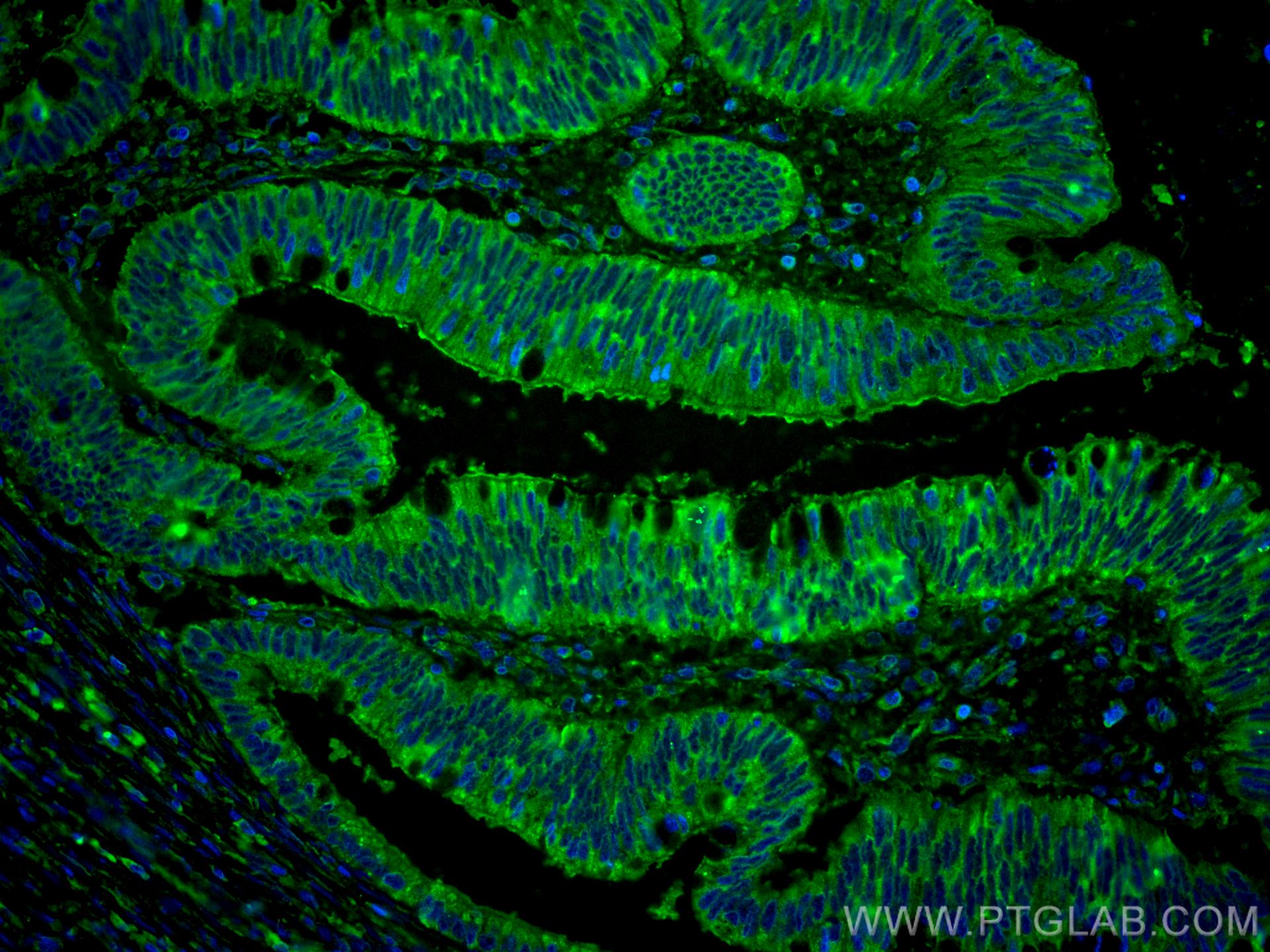 Immunofluorescence (IF) / fluorescent staining of human colon cancer tissue using CoraLite® Plus 488-conjugated ST6GALNAC6 Monoclona (CL488-66209)