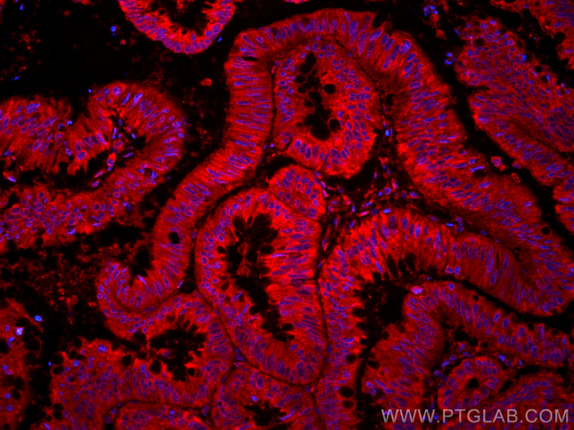 Immunofluorescence (IF) / fluorescent staining of human colon cancer tissue using CoraLite®594-conjugated ST6GALNAC6 Monoclonal anti (CL594-66209)