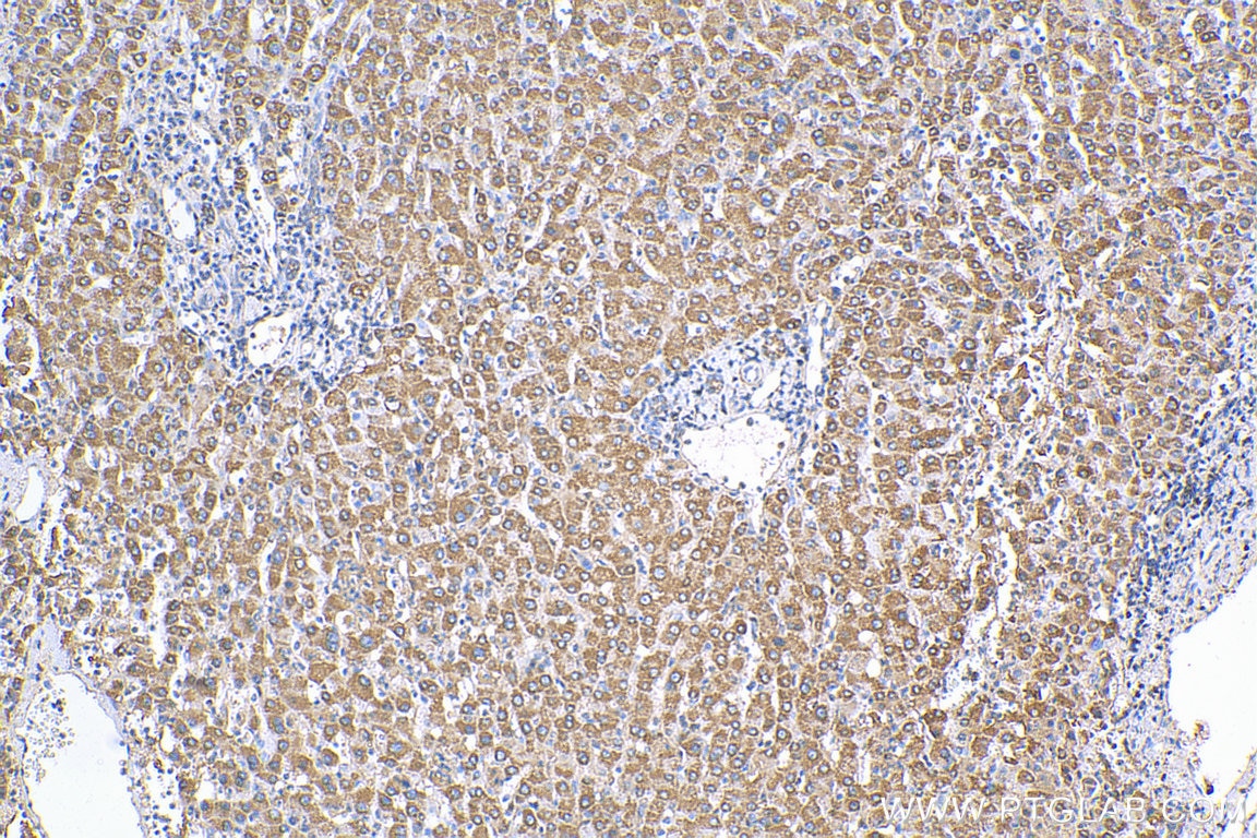 Immunohistochemistry (IHC) staining of human liver cancer tissue using ST7 Polyclonal antibody (11945-1-AP)