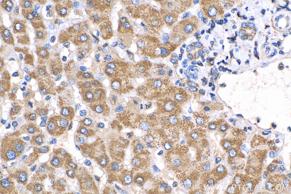 Immunohistochemistry (IHC) staining of human liver cancer tissue using ST7 Polyclonal antibody (11945-1-AP)