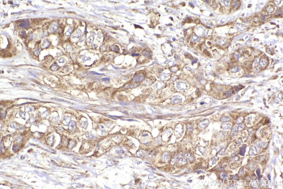 Immunohistochemistry (IHC) staining of human pancreas cancer tissue using ST7 Polyclonal antibody (11945-1-AP)