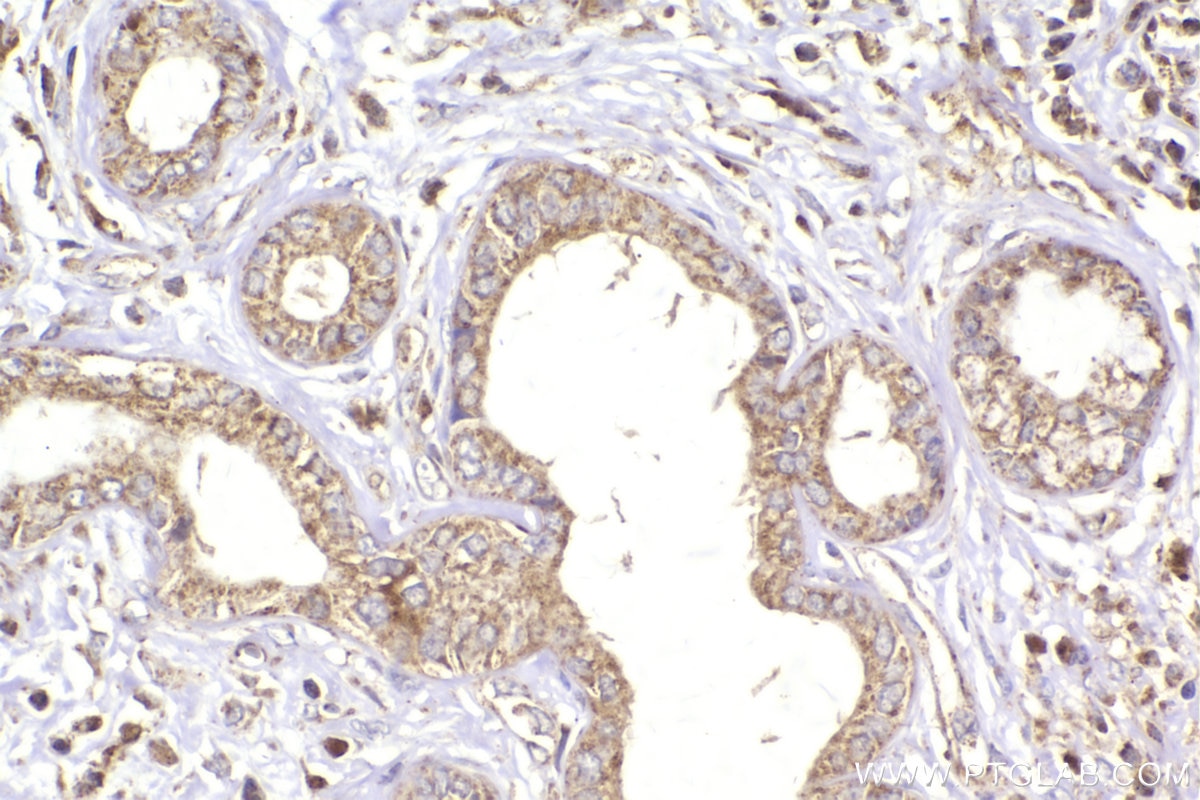 Immunohistochemistry (IHC) staining of human pancreas cancer tissue using ST7 Polyclonal antibody (11945-1-AP)