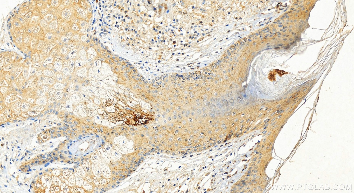 Immunohistochemistry (IHC) staining of human paracancerous of skin cancer using ST8SIA1 Polyclonal antibody (24918-1-AP)