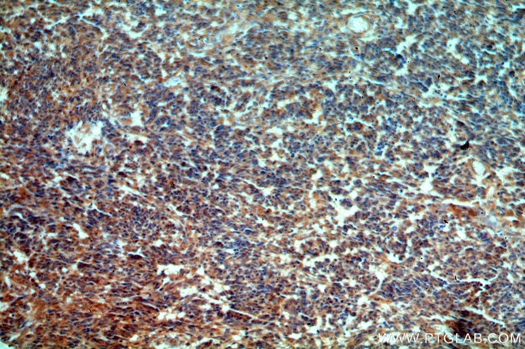 IHC staining of human gliomas using 20392-1-AP