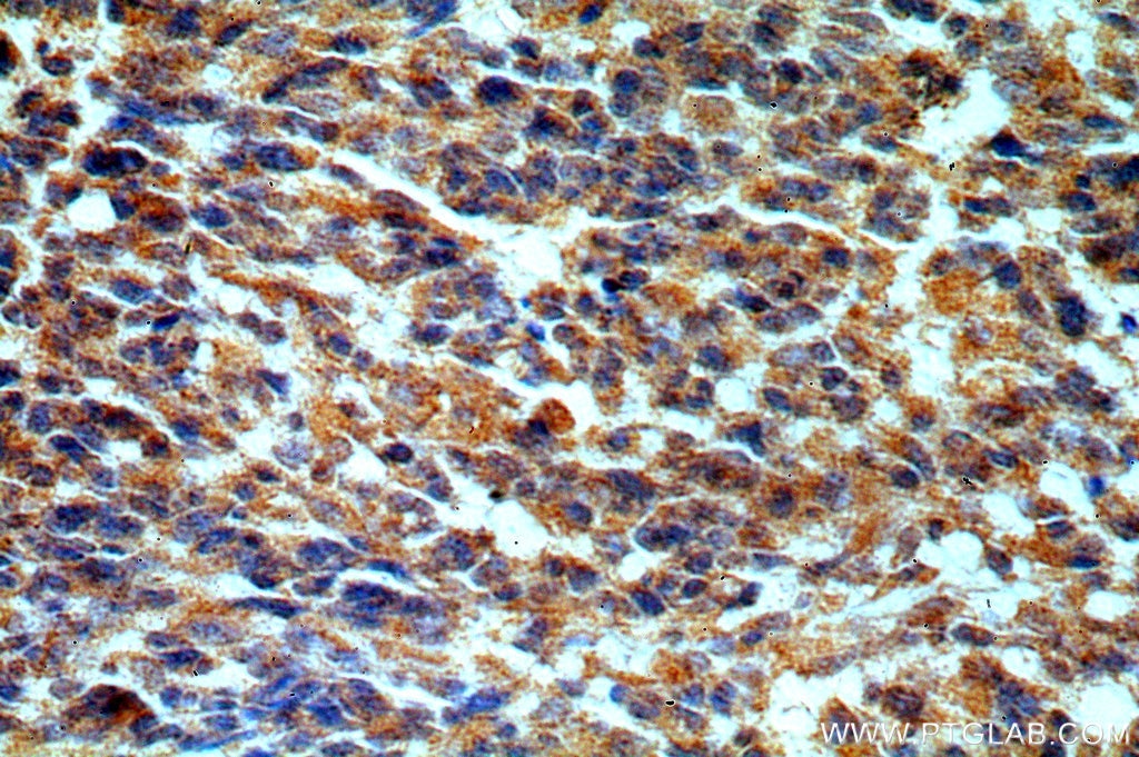 Immunohistochemistry (IHC) staining of human gliomas tissue using STAC3 Polyclonal antibody (20392-1-AP)