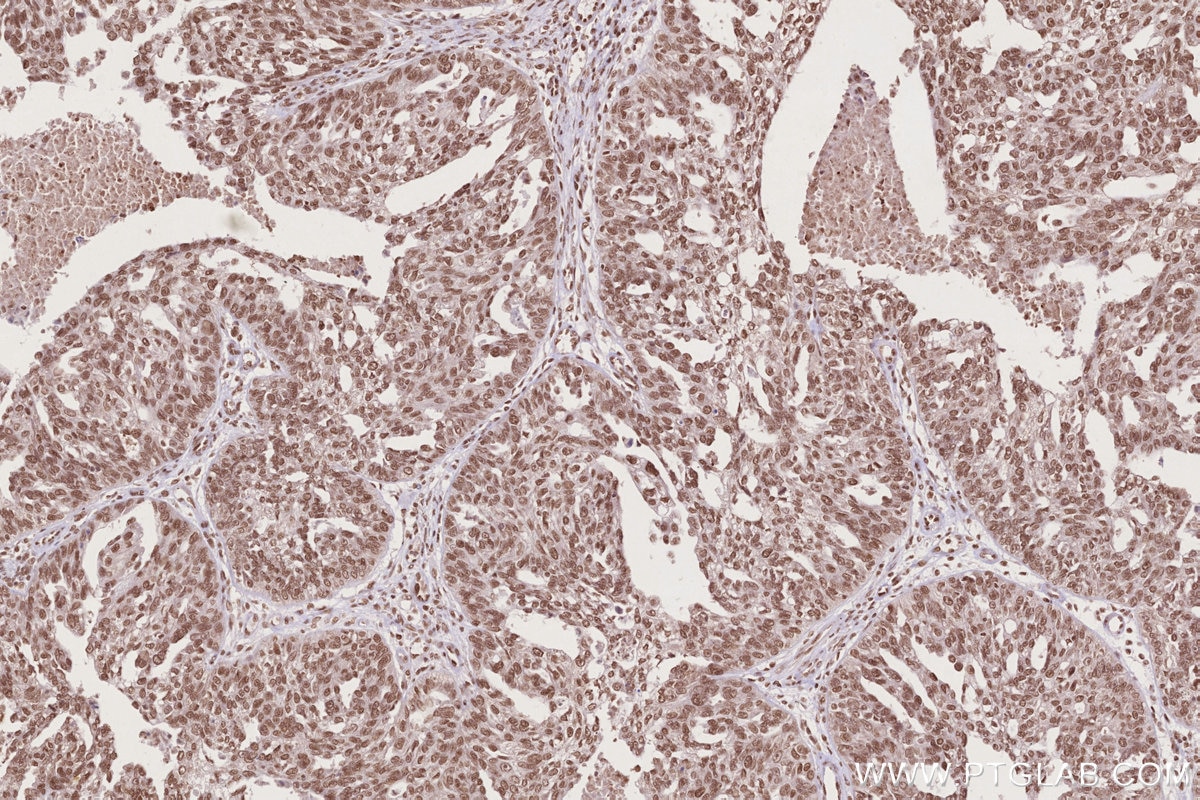 IHC staining of human ovary cancer using 14015-1-AP Immunohistochemistry (IHC) staining of human ovary cancer tissue using STAG1 Polyclonal antibody (14015-1-AP)