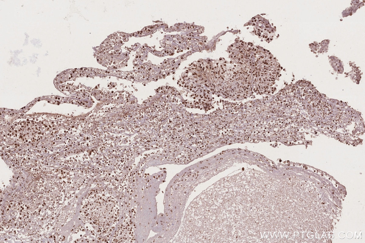 IHC staining of human ovary cancer using 14015-1-AP Immunohistochemistry (IHC) staining of human ovary cancer tissue using STAG1 Polyclonal antibody (14015-1-AP)