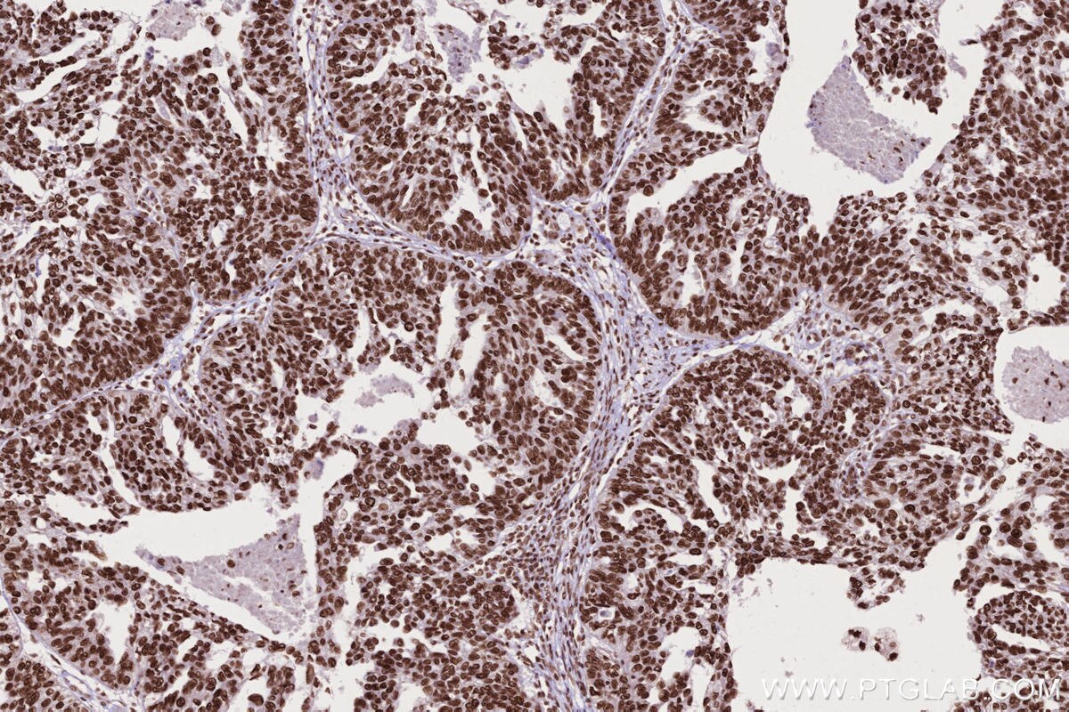 Immunohistochemistry (IHC) staining of human ovary cancer tissue using STAG2 Polyclonal antibody (19837-1-AP)