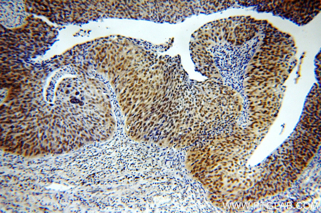 Immunohistochemistry (IHC) staining of human cervical cancer tissue using STAG2 Polyclonal antibody (19837-1-AP)