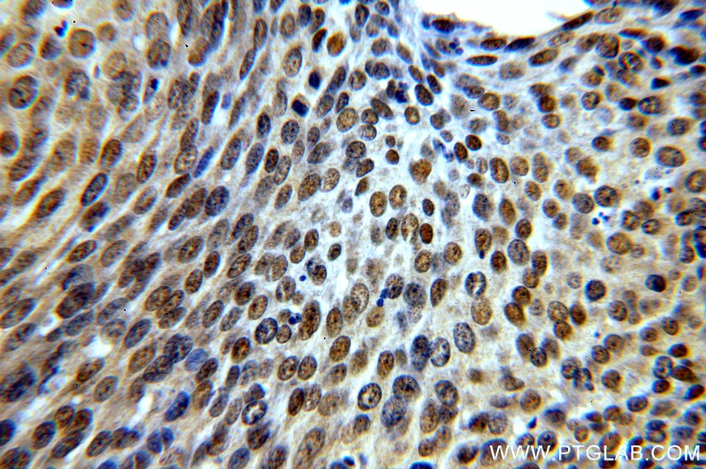 Immunohistochemistry (IHC) staining of human cervical cancer tissue using STAG2 Polyclonal antibody (19837-1-AP)