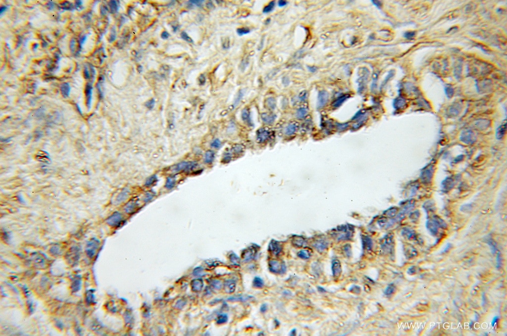 Immunohistochemistry (IHC) staining of human prostate cancer tissue using STAMBP Polyclonal antibody (11346-1-AP)