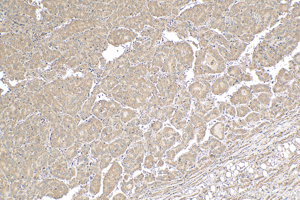Immunohistochemistry (IHC) staining of human liver cancer tissue using STAR Polyclonal antibody (12225-1-AP)