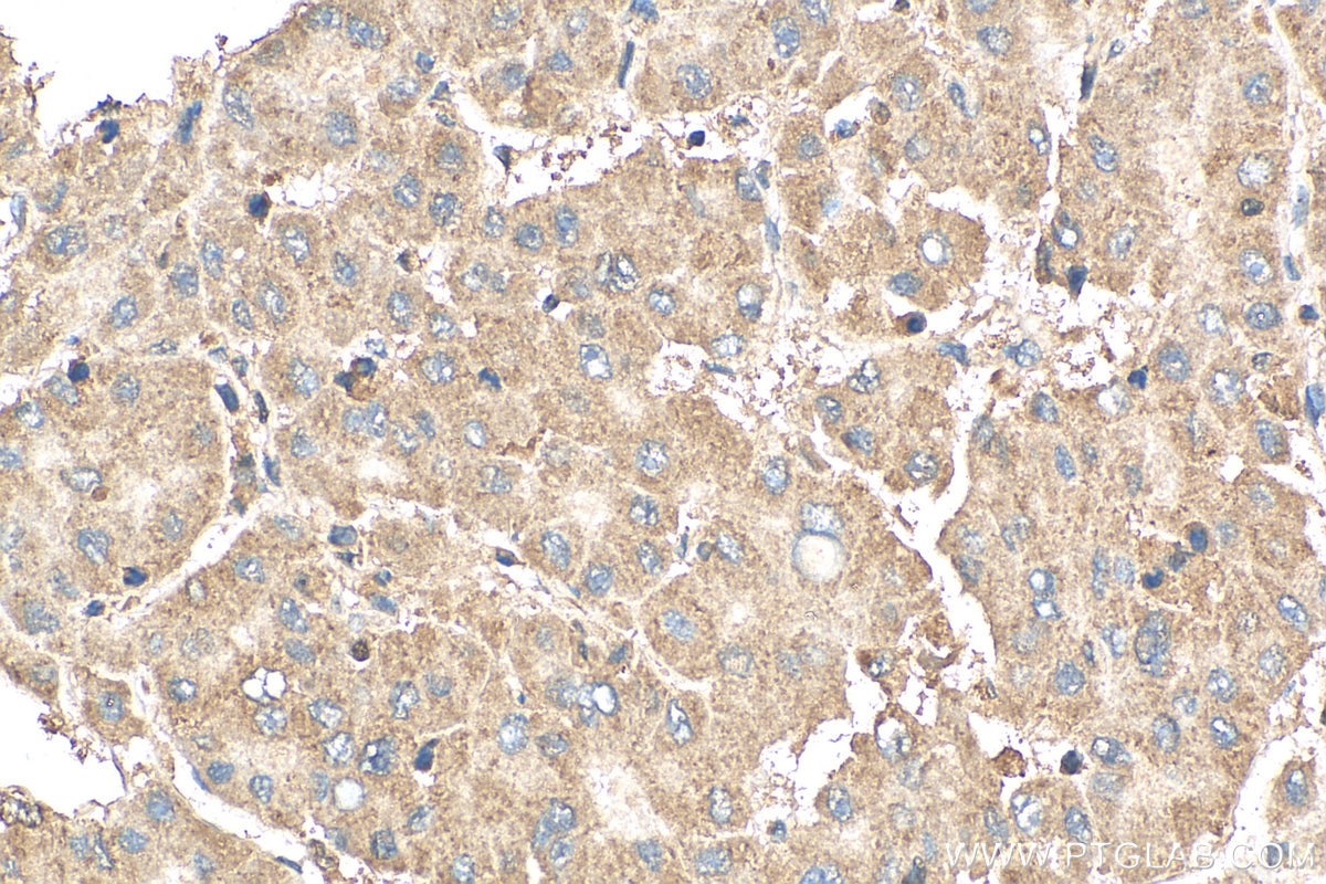 IHC staining of human liver cancer using 12225-1-AP