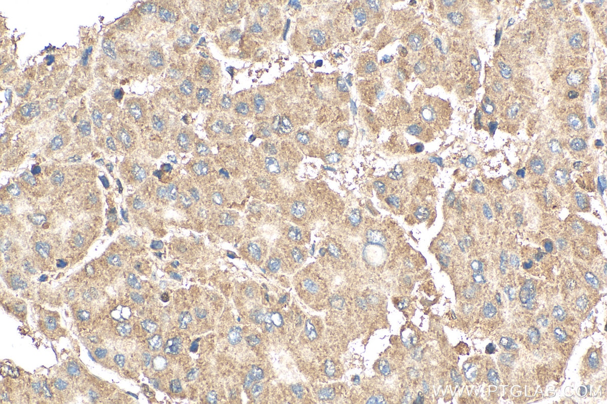 Immunohistochemistry (IHC) staining of human liver cancer tissue using STAR Polyclonal antibody (12225-1-AP)