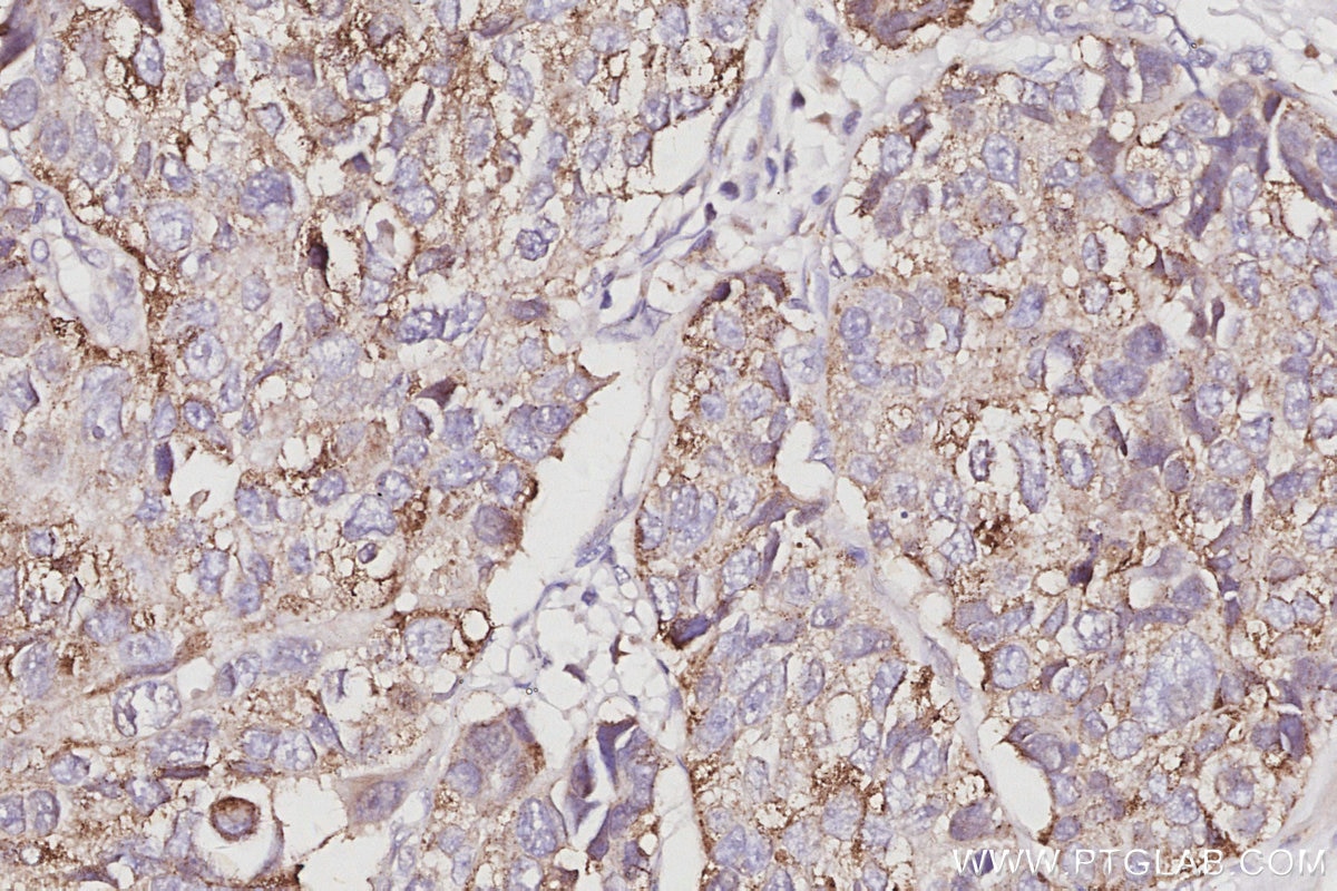 Immunohistochemistry (IHC) staining of human stomach cancer tissue using STARD13 Polyclonal antibody (21325-1-AP)