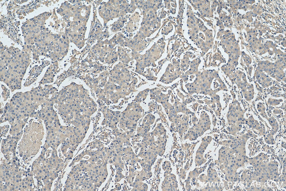Immunohistochemistry (IHC) staining of human breast cancer tissue using STARD3NL Polyclonal antibody (20502-1-AP)