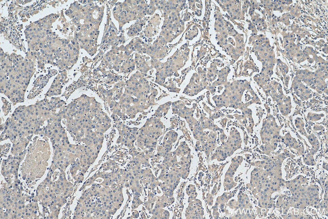 Immunohistochemistry (IHC) staining of human breast cancer tissue using STARD3NL Polyclonal antibody (20502-1-AP)