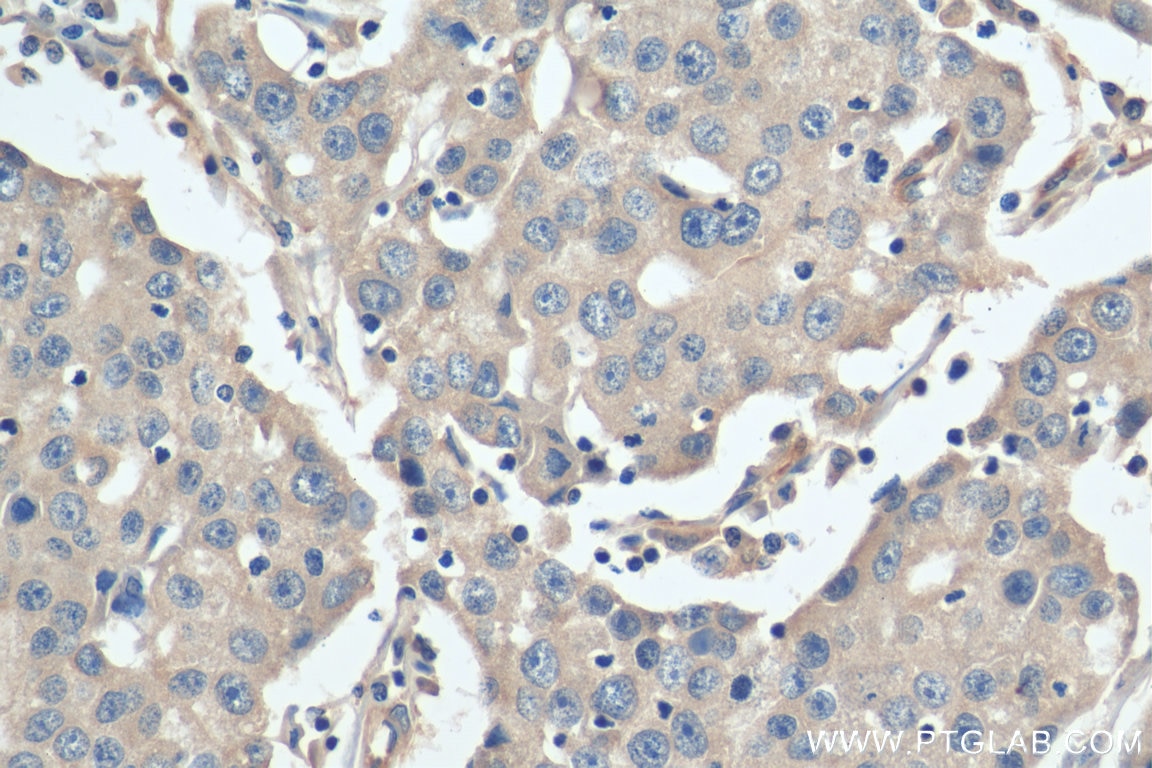 IHC staining of human breast cancer using 20502-1-AP