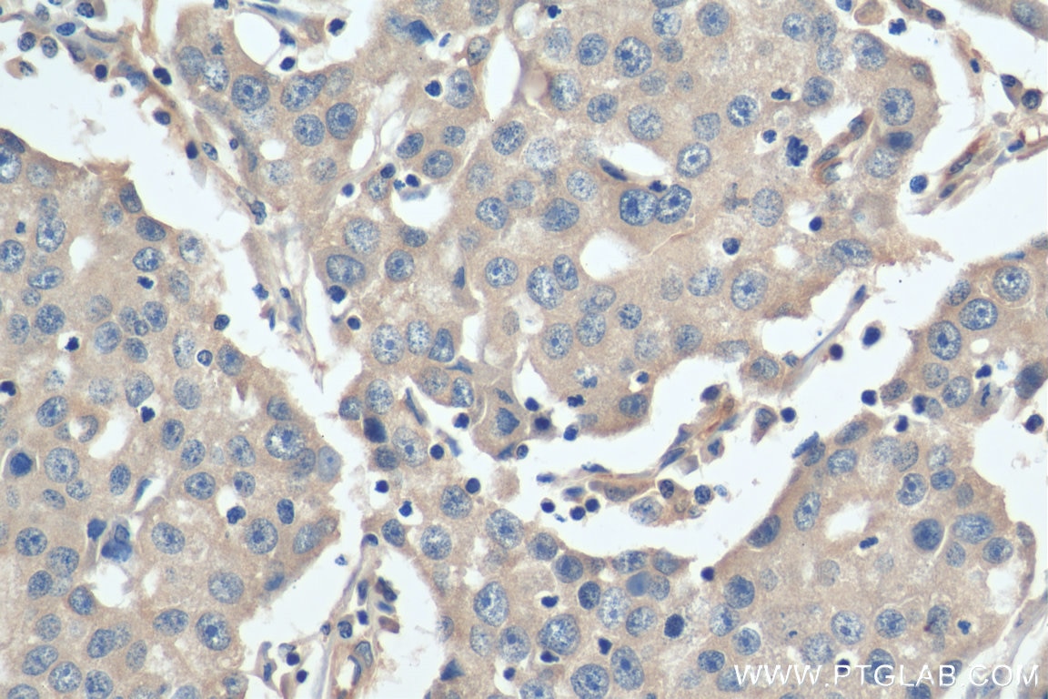 Immunohistochemistry (IHC) staining of human breast cancer tissue using STARD3NL Polyclonal antibody (20502-1-AP)