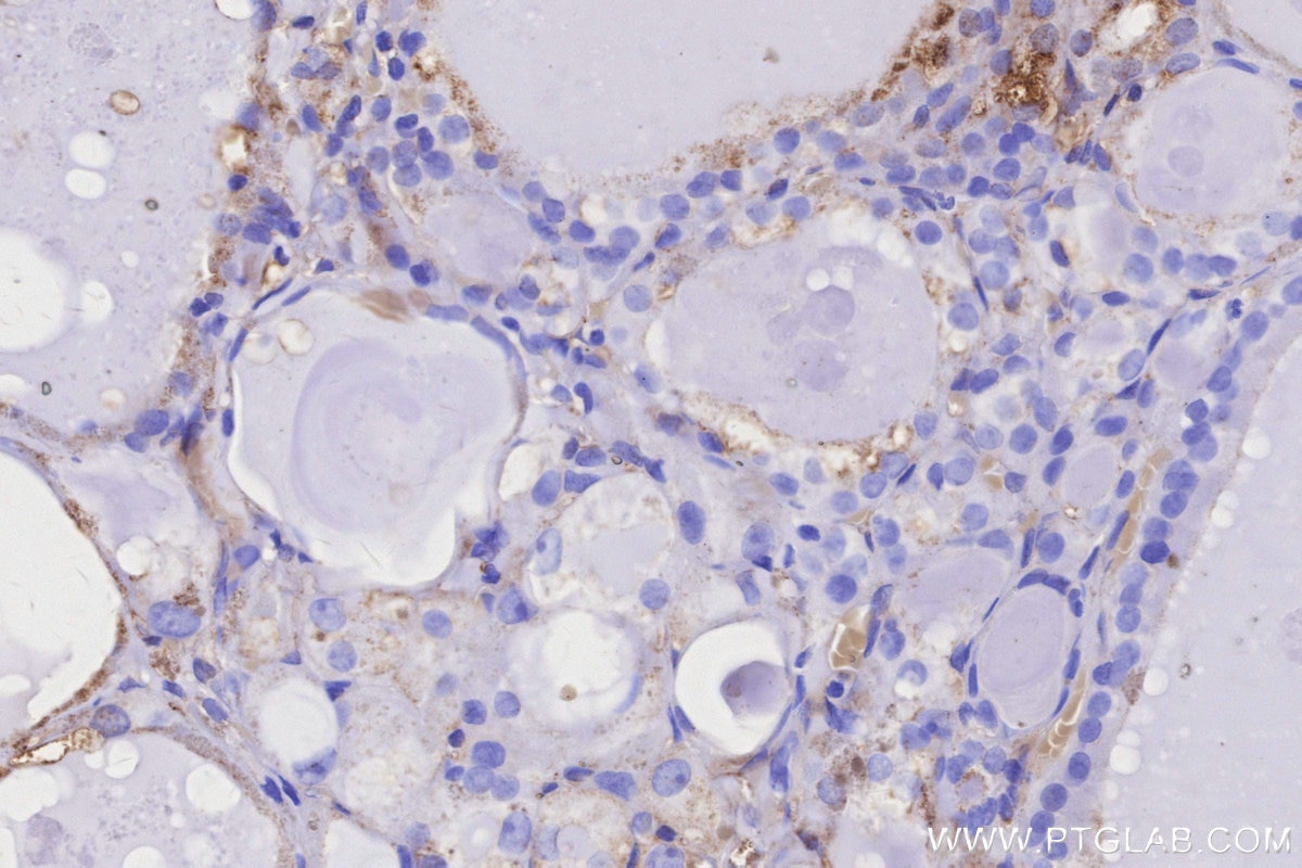 IHC staining of human thyroid cancer using 20502-1-AP Immunohistochemistry (IHC) staining of human thyroid cancer tissue using STARD3NL Polyclonal antibody (20502-1-AP)